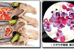 多发性骨髓瘤症状,CRAB四症状与并发症全面解读